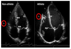 Apical four chamber echocardiogram comparing the heart of a 23-year-old non-athlete (left) with that of a 23-year-old professional cyclist.