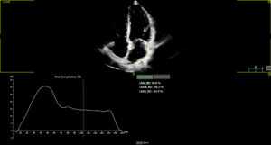 Automated LA strain analysis