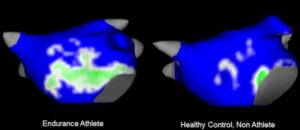 CMR may demonstrate enlargement and scarring of the atriae of endurance athletes