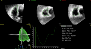 Cardiac ultrasound evaluates the right ventricle